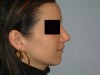 rhinoplastie